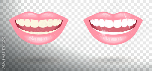 Smile with Clean and White Teeth and a Smile with Dirty Teeth