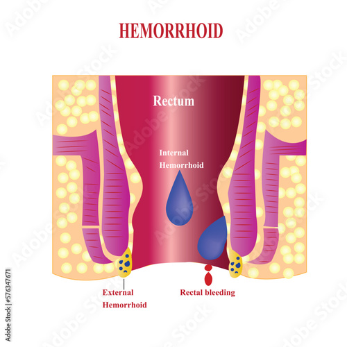 Internal hemorrhoids and external hemorrhoids. Hemorrhoids and inflammation cause bleeding through the fistula of the patient.Cross section of the rectum and anal canal photo