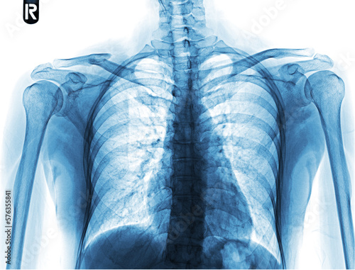 Photography X-ray images of the shoulder show future right shoulder