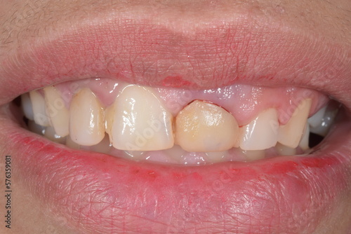 Dentistry condition of a patient with oral disease located in the central incisor because of dental decay, a bad resin composite restauration and gingiva gum periodontal inflammatory bleeding. 