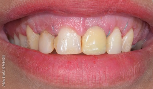 Εκτύπωση καμβά Frontal view of a woman mouth smiling with fake teeth of porcelain fixed prosthetic dental crown in central incisor  and gingiva surgery and surgical suture thread
