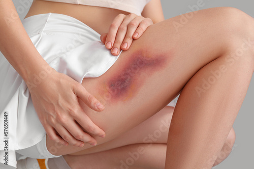 Young woman with bruised leg on grey background, closeup © Pixel-Shot