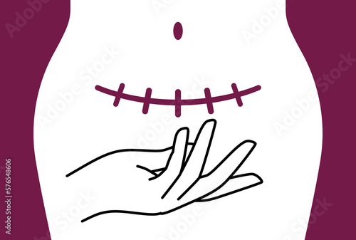 Cesarean Awareness Month. Day of surgical births of pregnant woman