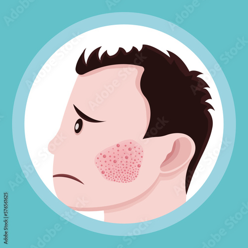 person with acne on the face