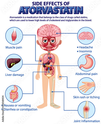 Human anatomy diagram cartoon style of Atorvastatin side effects