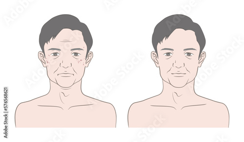 50代から60代くらいの男性の顔の老化、変化、ビフォーアフターのイメージイラスト