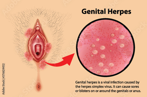 Genital Herpes infographic with explanation photo
