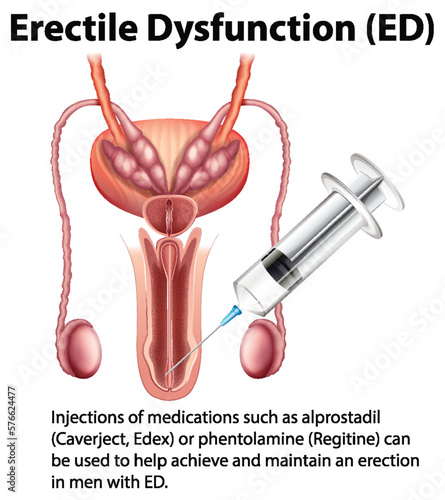 Erectile Dysfunction (ED) infographic with explanation