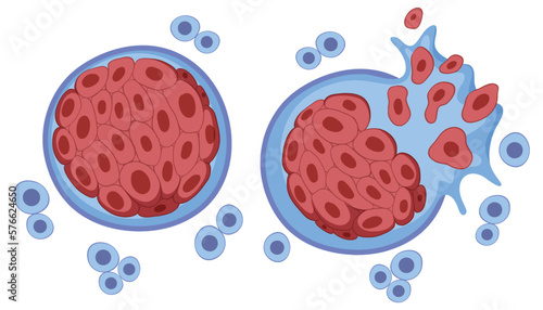 Tumor cell and cancer development