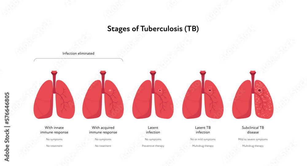 Tuberculosis disease concept Vector flat healthcare illustration