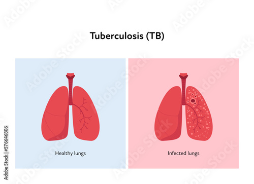 Tuberculosis disease concept. Vector flat healthcare illustration. Healthy and infected lung on red and blue background. Design element for health care, education, pulmonology