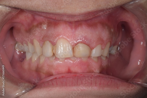 Dentistry aesthetic condition with oral disease in the central incisor because of dental decay, a bad resin composite restauration and gingiva gum misaligned with periodontal inflammatory bleeding. 