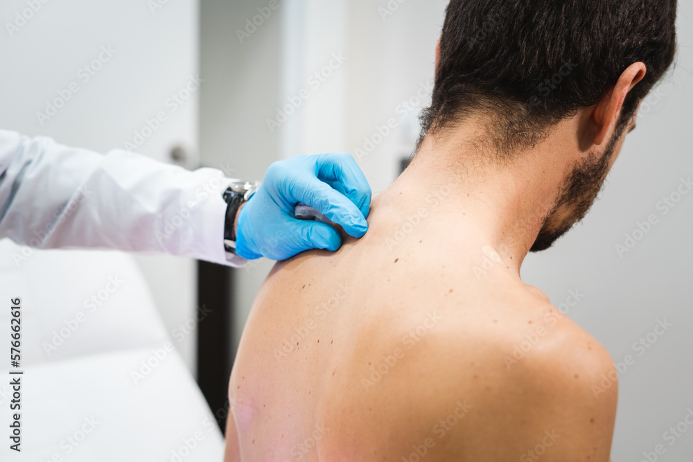 Espalda de paciente siendo examinada por dermatólogo con guantes para observación de lunares - obrazy, fototapety, plakaty 