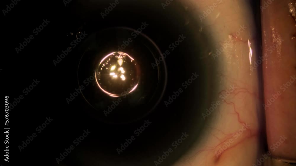 Eye surgery, vitreoretinal. Vitrectomy surgery. Eye surgery, vitreoretinal. Vitrectomy surgery.