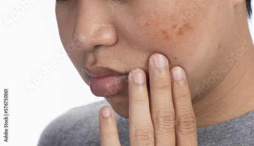Young man worry dark spots and melasma on his face.