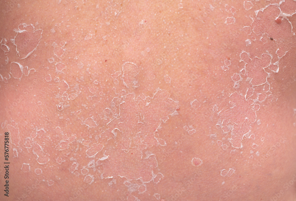 Fototapeta premium Sunburn, close-up of human skin. Flaky skin from allergies, peeling or eczema. Dry skin in need of treatment and hydration.