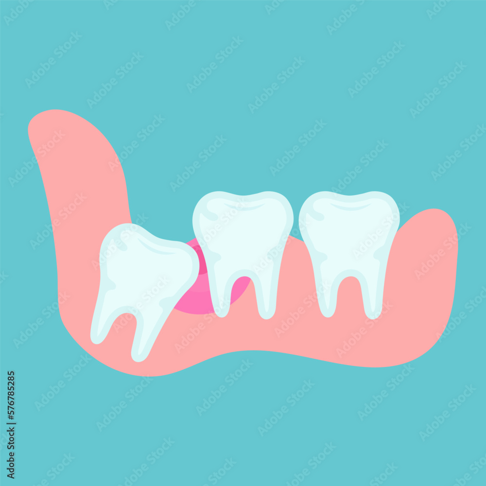 Impacted wisdom tooth. Wisdom tooth moving. Wisdom tooth under the gum. Toothache. Dental or orthodontical concept. Vector Impacted wisdom tooth. Wisdom tooth moving. Wisdom tooth under the gum. Toothache. Dental or orthodontical concept. Vector