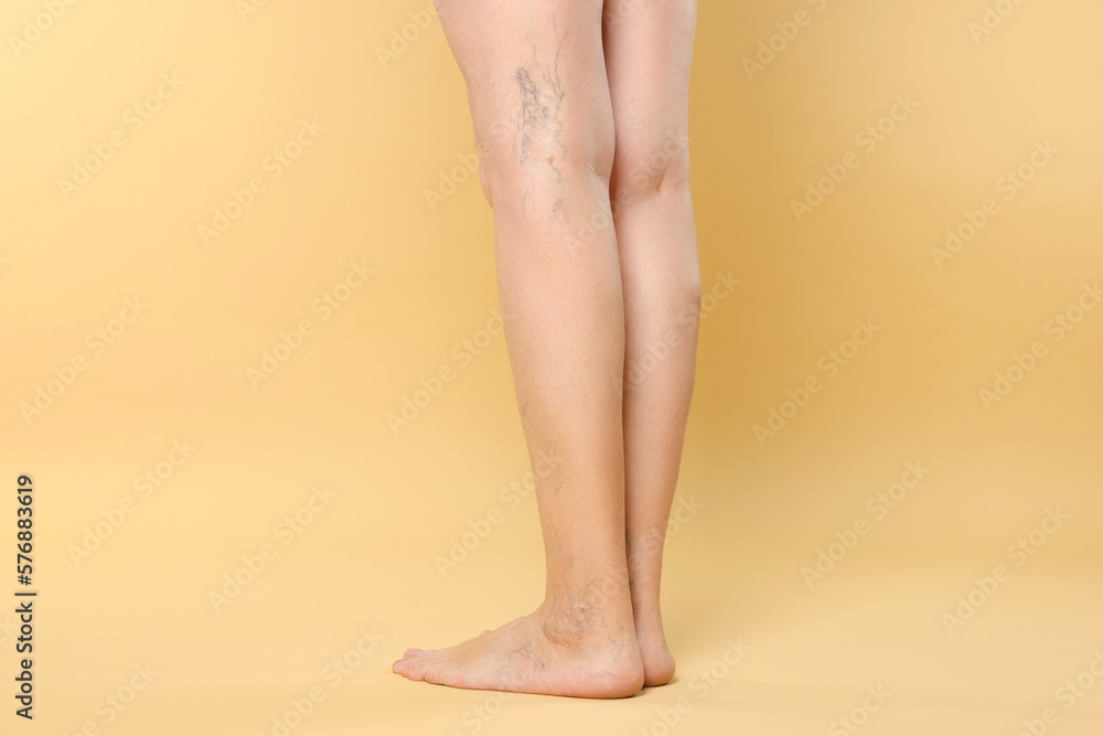 Closeup view of woman with varicose veins on yellow background