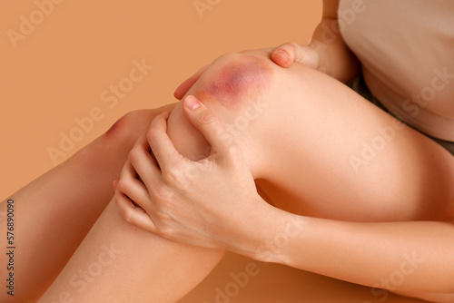Young woman with bruised legs on beige background, closeup