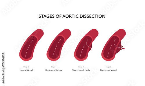Blood vessel anatomy disease infographic chart. Vector color flat illustration. Aortic cross section with stages of dissection anatomical diagram. Design for healthcare, cardiology, education.