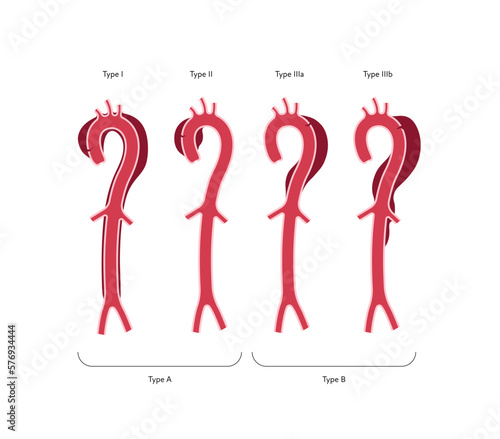Blood vessel anatomy disease infographic chart. Vector color flat illustration. Aortic cross section with types of aneurism anatomical diagram. Design for healthcare, cardiology, education.