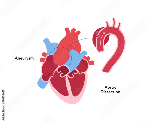 Heart anatomy disease infographic chart. Vector color flat illustration. Inner organ cross section with aortic aneurism dissection anatomical diagram. Design for healthcare, cardiology, education. photo
