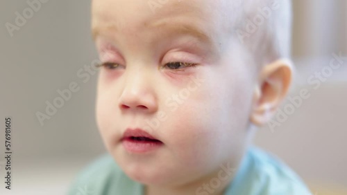 baby child face with conjunctivitis symptoms eyes red color swelling conjunctiva eyelids. increased tear production, irritation around eye. kids eyes with pink eye disease illness after flu cold photo