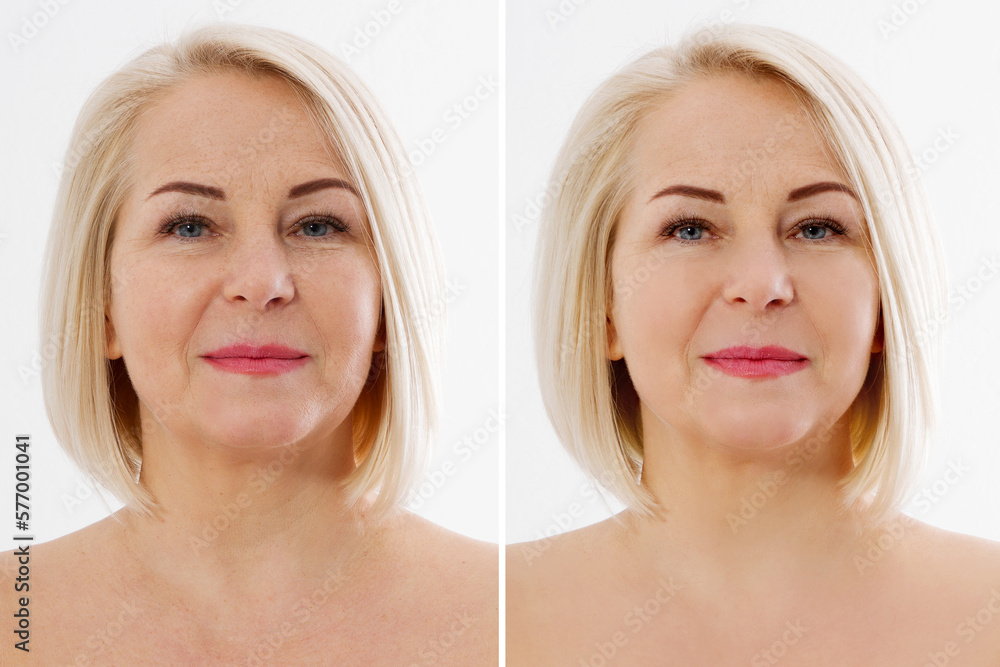 Closeup before after Beauty middle age woman face portrait. Before 