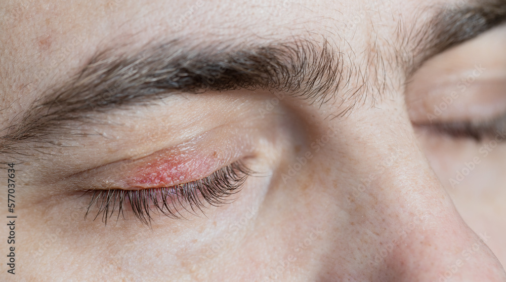 Peeling and swelling on the eyelid of the human eye.