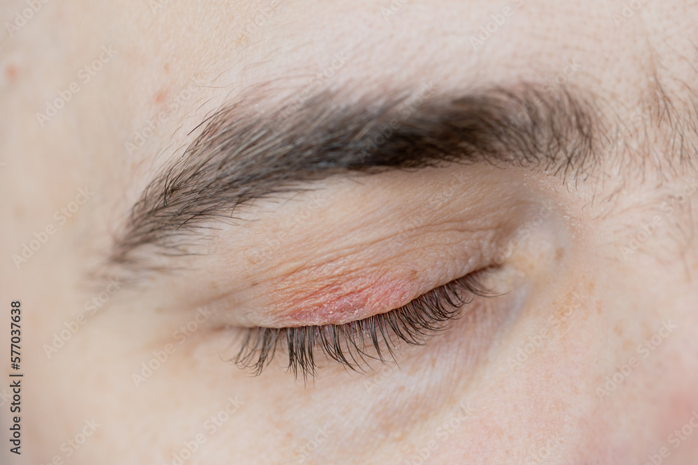 Peeling and swelling on the eyelid of the human eye. Stock Photo