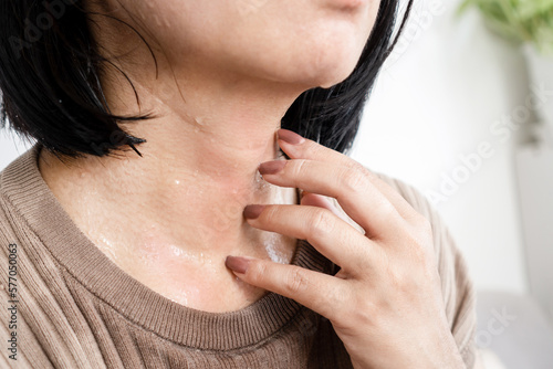 closeup woman hand scratching  itchy skin on her neck caused by allergic to sweat from hot weather photo