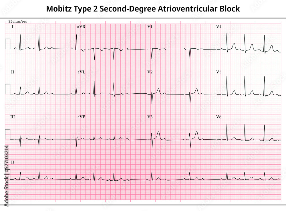 Mobitz Type 2 Second Degree Atrioventricular Block - ECG Paper 12 Lead ...