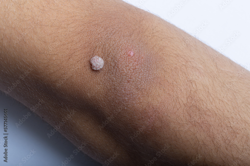Naklejka premium close up of a body, Visible Wart on Arm, Verruca on Arm in Close-up