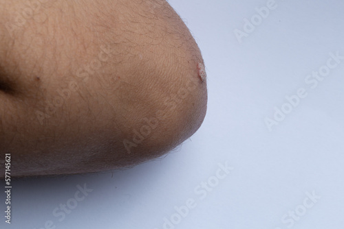 Close-up of Wart on Boy's Arm, Macro Shot of Wart on Arm photo