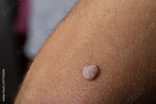 Close-up of Wart on Boy's Arm photo