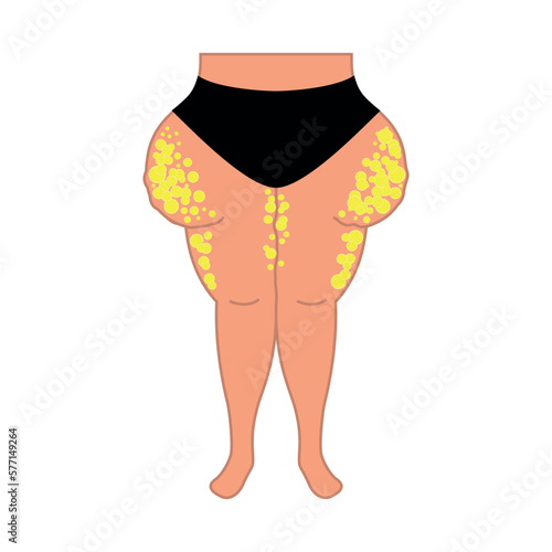 Lipedema fat cells on female body