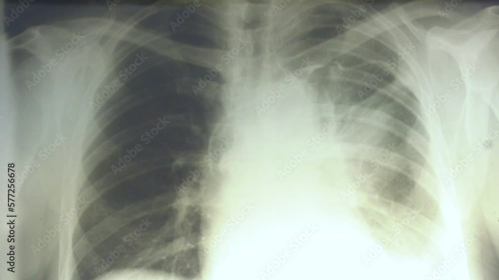 Photo breast x-rays located on a negatoscope. normal radiography of chest organs in direct projection, Traumatology and orthopedics, pulmonology
Photo breast x-rays located on a negatoscope. normal radiography of chest organs in direct projection, Traumatology and orthopedics, pulmonology