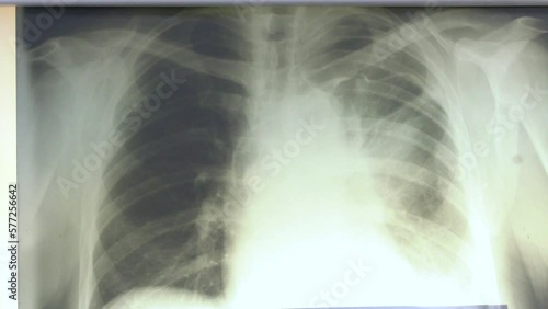 Photo breast x-rays located on a negatoscope. normal radiography of chest organs in direct projection, Traumatology and orthopedics, pulmonology
 photo