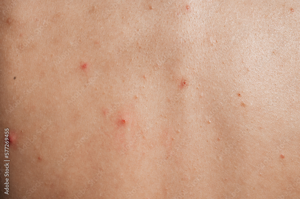 Close-up of the skin of a young girl with problems. Pimples, acne, pores, scars. Natural skin without filters Close-up of the skin of a young girl with problems. Pimples, acne, pores, scars. Natural skin without filters