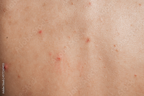 Close-up of the skin of a young girl with problems. Pimples  acne  pores  scars. Natural skin without filters