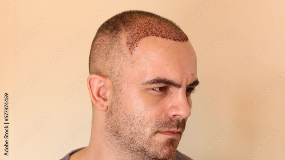 Man with newly transplanted hair, scabs still covering it. One week has passed since the operation. Man with newly transplanted hair, scabs still covering it. One week has passed since the operation.