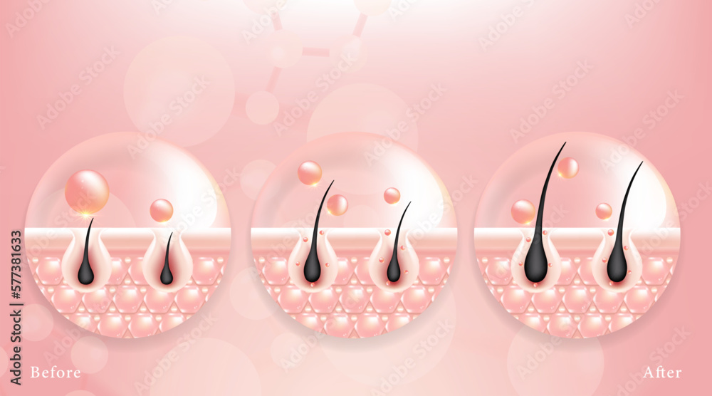 Hyaluronic acid before and after hair and skin solutions ad. pink collagen serum drop into skin cells with cosmetic advertising background ready to use, illustration vector.