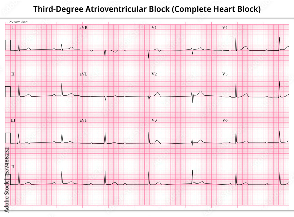 Third Degree Atrioventricular Block - ECG Paper 12 Lead ...