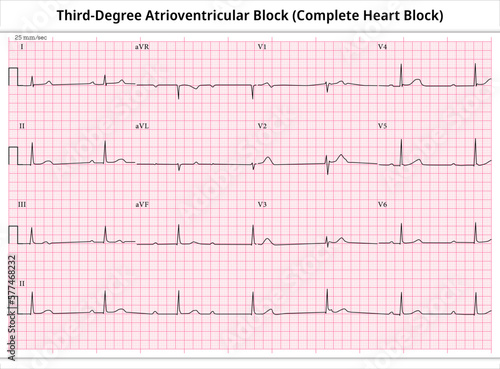 Third Degree Atrioventricular Block - ECG Paper 12 Lead - Electrocardiogram - Vector Medical Illustration