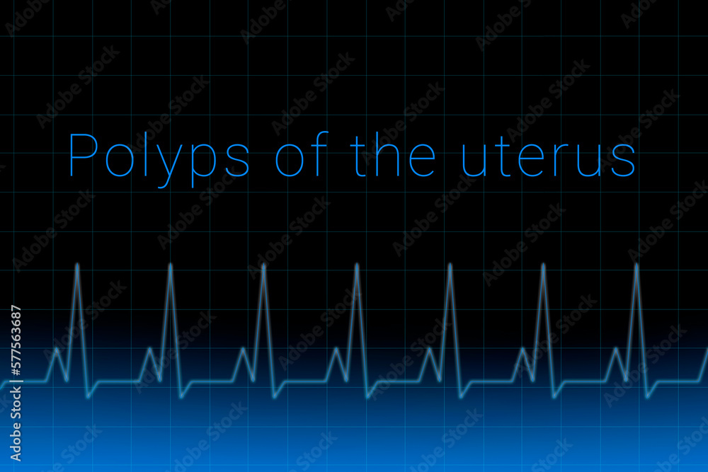 Polyps of the uterus disease. Polyps of the uterus logo on a dark background. Heartbeat line as a symbol of human disease. Concept Medication for disease Polyps of the uterus. Polyps of the uterus disease. Polyps of the uterus logo on a dark background. Heartbeat line as a symbol of human disease. Concept Medication for disease Polyps of the uterus.