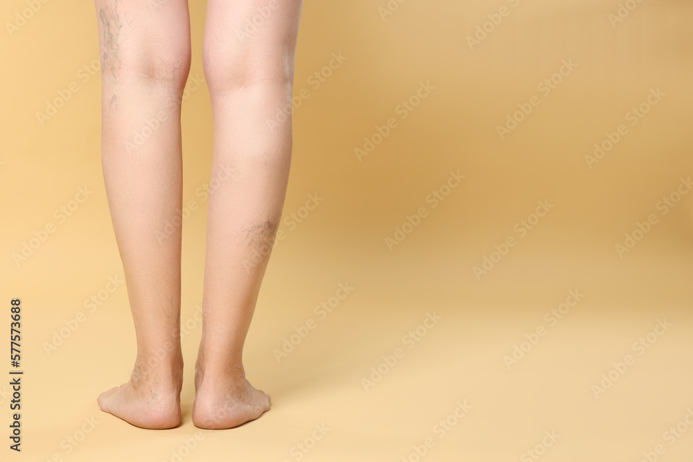 Closeup view of woman with varicose veins on yellow background. Space for text Closeup view of woman with varicose veins on yellow background. Space for text