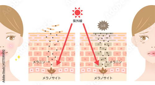 シミのしくみと紫外線　女性の肌の断面図　ビフォアアフター
