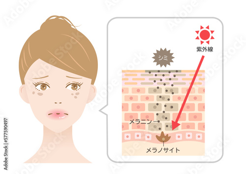 シミのしくみと紫外線　女性　肌の断面図