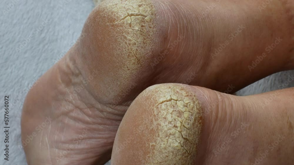 Cracked skin on the heel of a man. Cope plan of the heel of a man with numerous and deep cracks. Concept of skin problems cracks, flaking, eczema, psoriasis, peeling, fungal infection, athlete's foot Cracked skin on the heel of a man. Cope plan of the heel of a man with numerous and deep cracks. Concept of skin problems cracks, flaking, eczema, psoriasis, peeling, fungal infection, athlete's foot