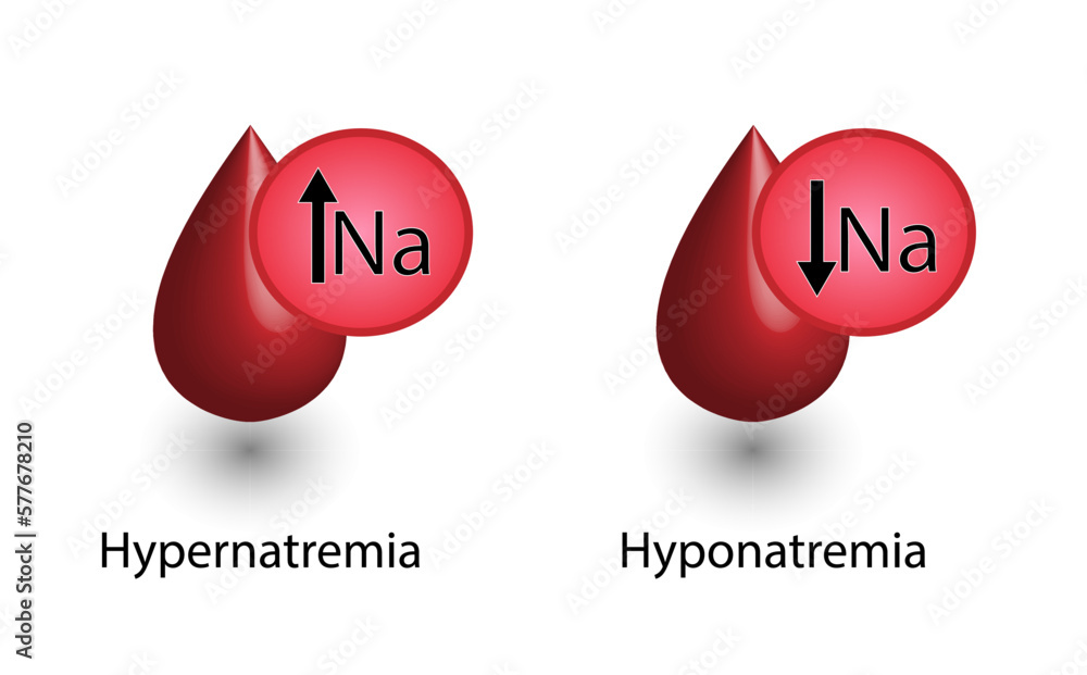 Hypernatremia, high plasma sodium level and Hyponatremia, low plasma